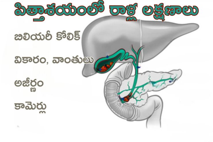 Symptoms of Gallstones