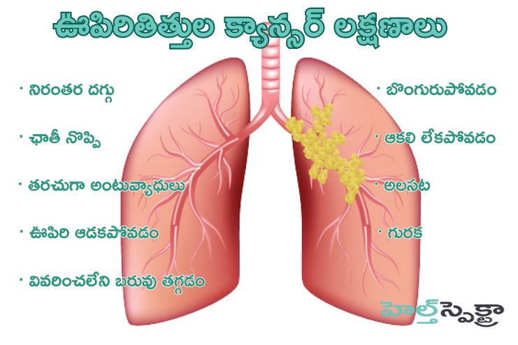 Symptoms of Lung Cancer