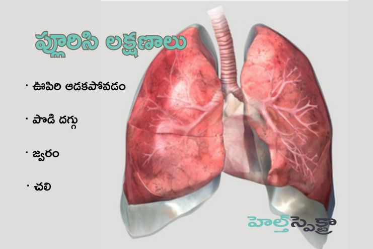 Symptoms of Pleurisy