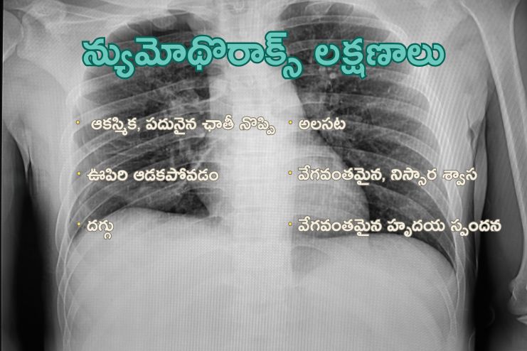 Symptoms of Pneumothorax