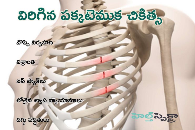 Treatment of a Broken Rib