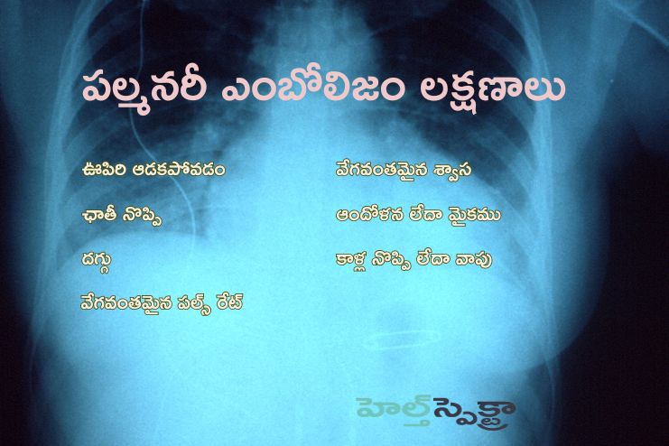 Symptoms of Pulmnary embolism