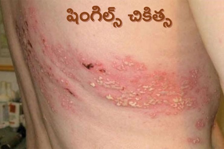 shingles treatment