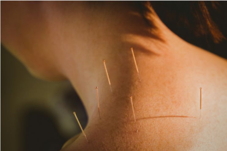 Acupuncture