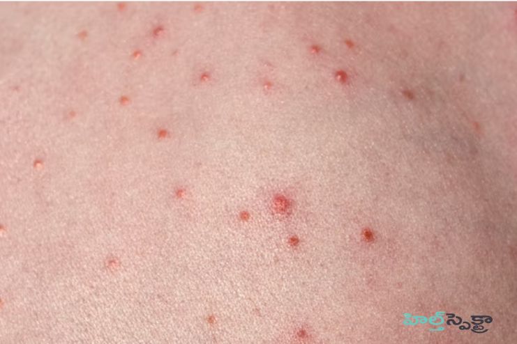 Ayurvedic Treatment of Folliculitis