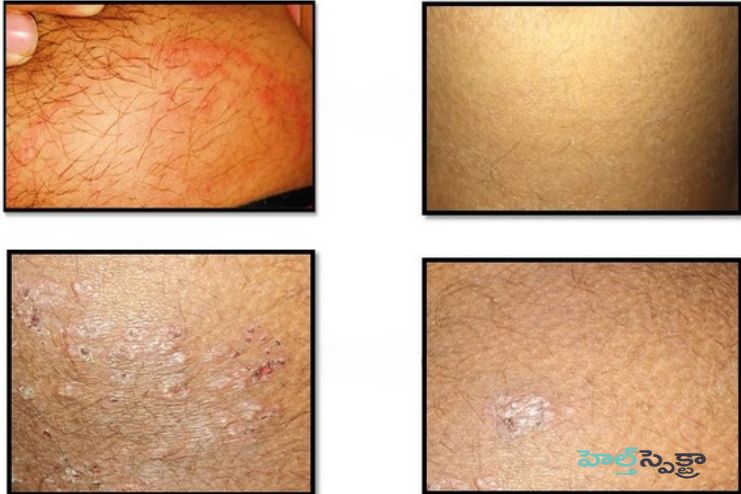Ayurvedic diagnosis of Folliculitis