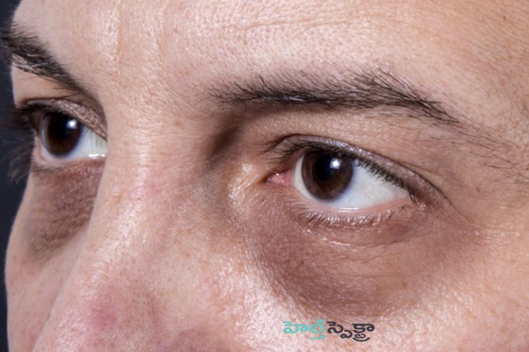 Bags Under Your Eyes
