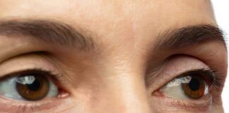 ఉబ్బిన కళ్ళు: లక్షణాలు, కారకాలు, చికిత్స, నివారణ - Bags Under Your Eyes: Causes, Symptoms, and Treatment Bags Under Your Eyes_ Causes, Symptoms, and Treatment