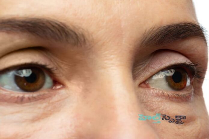 Bags Under Your Eyes_ Causes, Symptoms, and Treatment