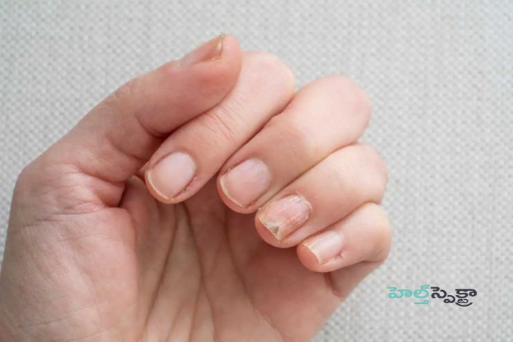 Can I prevent nail infections