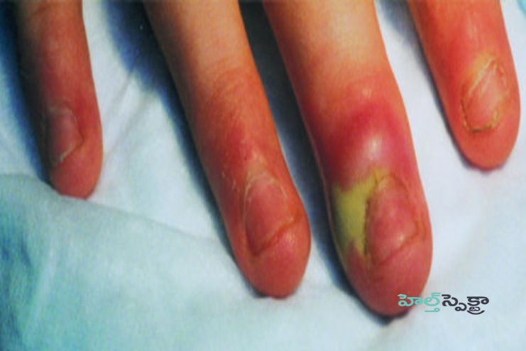 Can I treat paronychia at home