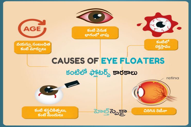 Causes of Eye Floaters