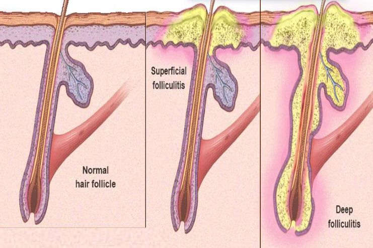 Causes of Folliculitis