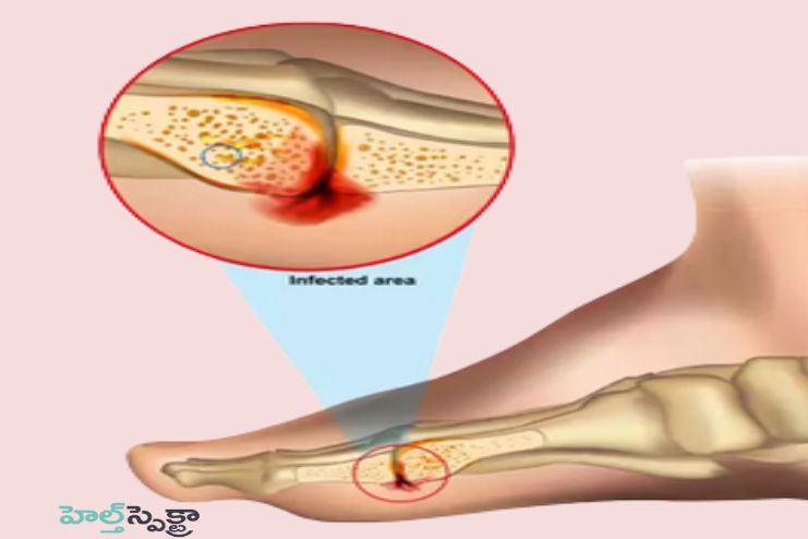 Causes of Osteomyelitis