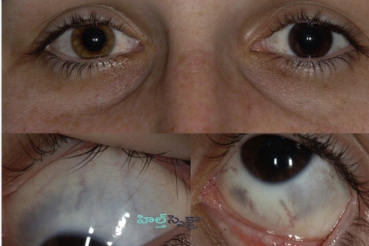 Causes of eye melanoma