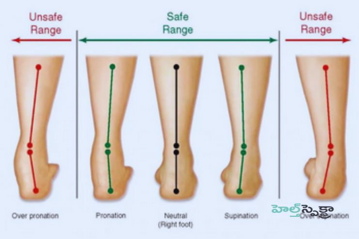 Diagnosis of Flatfeet