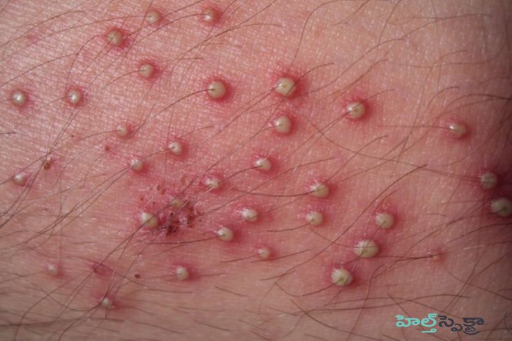 Eosinophilic folliculitis