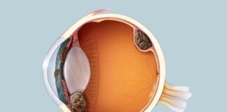 కంటిలో సంభవించే క్యాన్సర్ ‘కంటి మెలనోమా’ గురించి తెలుసా.? - Eye Melenoma: Causes, Symptoms and Treatment Eye Melenoma_ Causes, Symptoms and Treatment