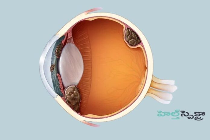 Eye Melenoma_ Causes, Symptoms and Treatment