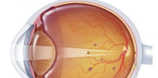 కంటిలో ఫ్లోటర్స్: లక్షణాలు, కారణాలు, చికిత్స - Eye floaters: Symptoms, causes, and Treatment Eye floaters_ Symptoms, causes, and Treatment