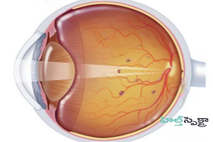 Eye floaters_ Symptoms, causes, and Treatment