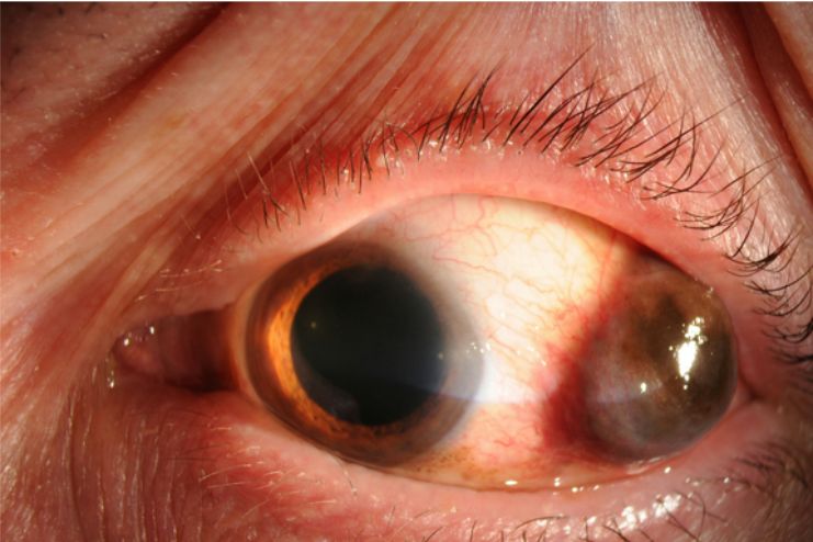 Eye melanoma biopsy
