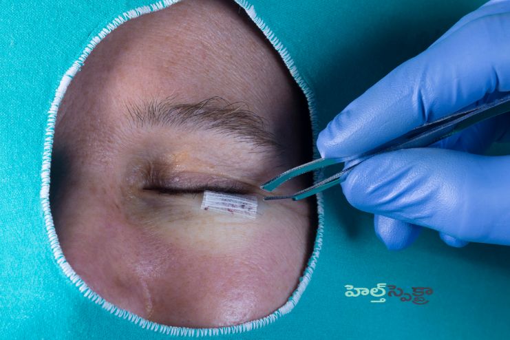 Eyelid surgery