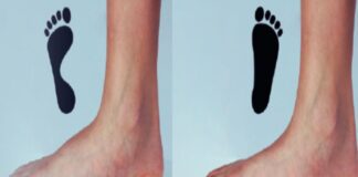 చదునైన పాదాలు (ఫ్లాట్ ఫీట్): లక్షణాలు, కారకాలు, చికిత్స - Flatfeet: Symptoms, causes, and Treatment Flatfeet_ Symptoms, causes, and Treatment