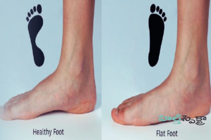 Flatfeet_ Symptoms, causes, and Treatment