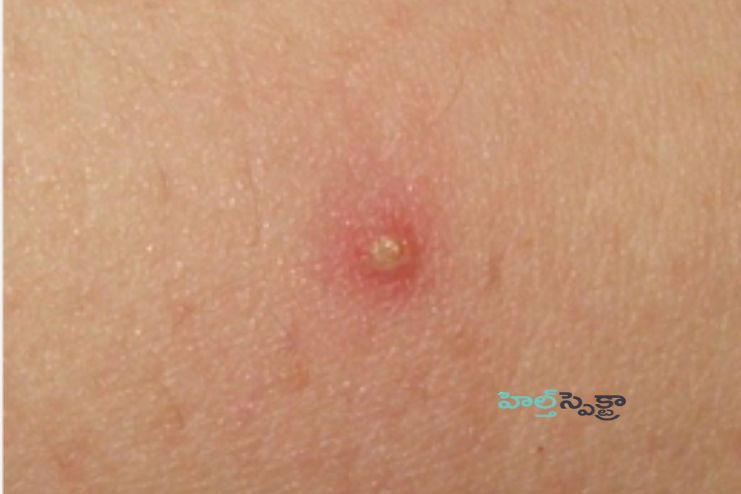 Folliculitis