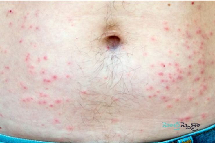 Hot tub folliculitis