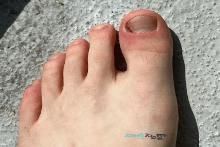 How common is paronychia