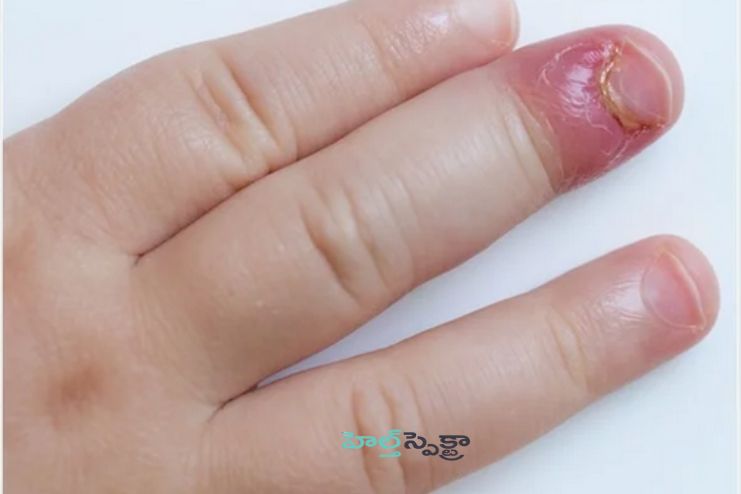 How is paronychia diagnosed