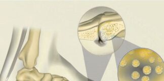 Osteomyelitis