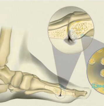 ఆస్టియోమైలిటిస్ (ఎముక ఇన్ఫెక్షన్) గురించి తెలుసా.? Osteomyelitis