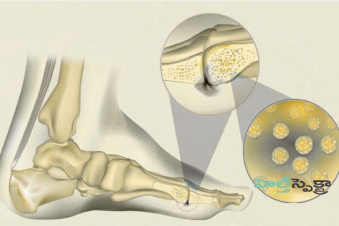 Osteomyelitis