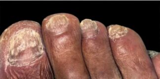 గోరుజుట్టు: కారకాలు, చికిత్స, నివారణ మార్గాలు - Paronychia: Nail Infection Symptoms and Treatment Paronychia_ Nail Infection Symptoms and Treatment