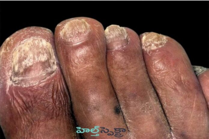 Paronychia_ Nail Infection Symptoms and Treatment