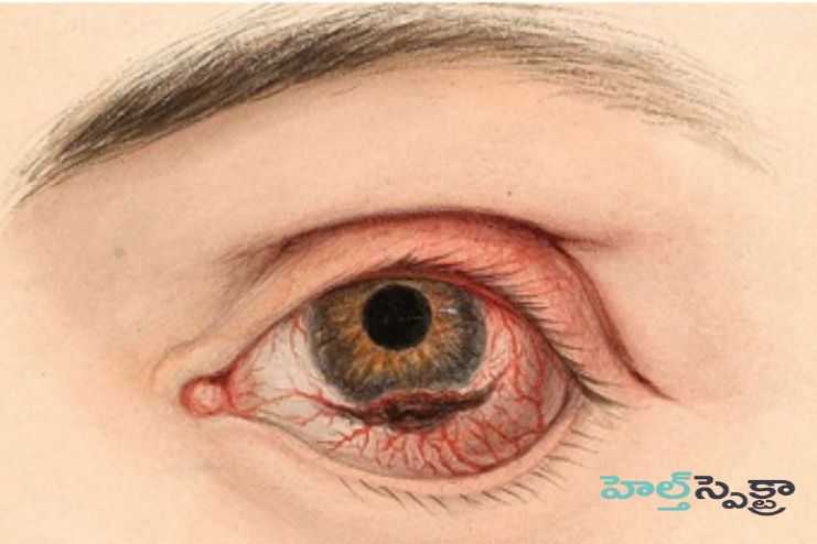 Photodynamic therapy for eye melanoma