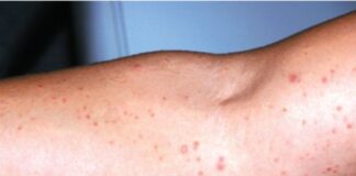 చీము పొక్కులు (ఫాలిక్యులైటిస్): కారకాలు, లక్షణాలు, ఆయుర్వేద చికిత్స - Folliculitis: Causes, Symptoms, and Effective Treatments Folliculitis- Causes, Symptoms and Treatment