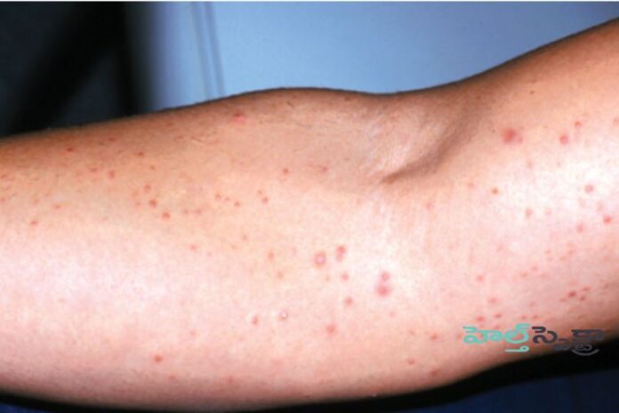 Folliculitis- Causes, Symptoms and Treatment
