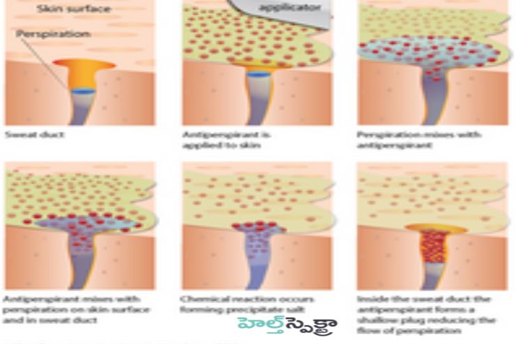 Prescription antiperspirant