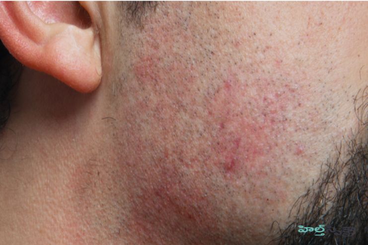 Pseudofolliculitis barbae
