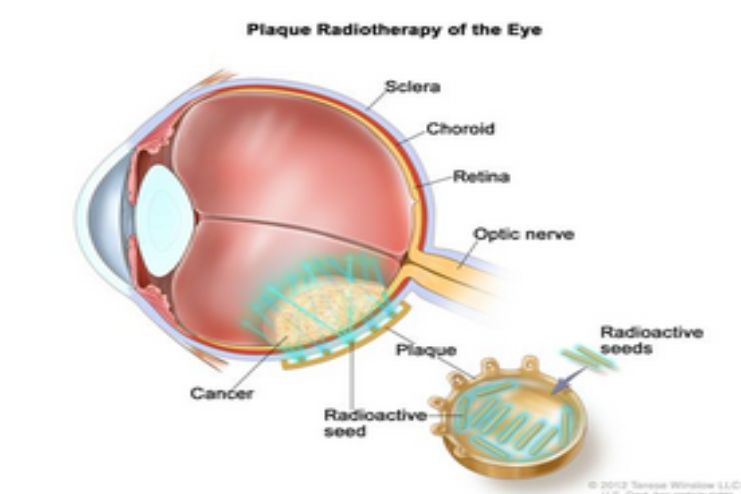 Radiation therapy for eye melanoma