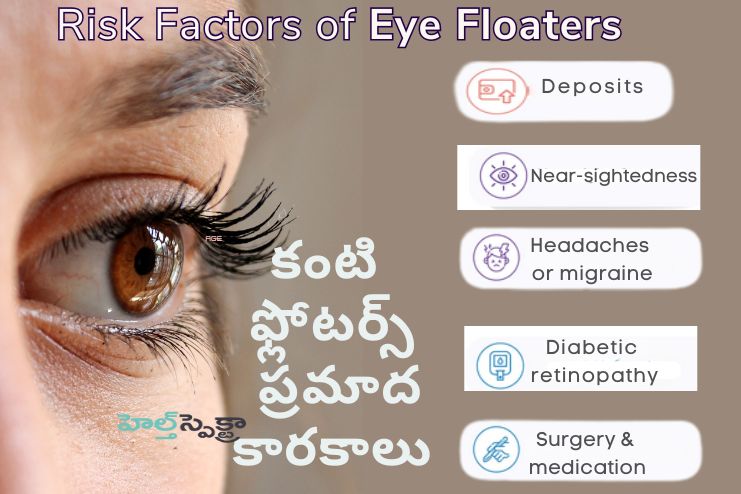 Risk factors of Eye floaters