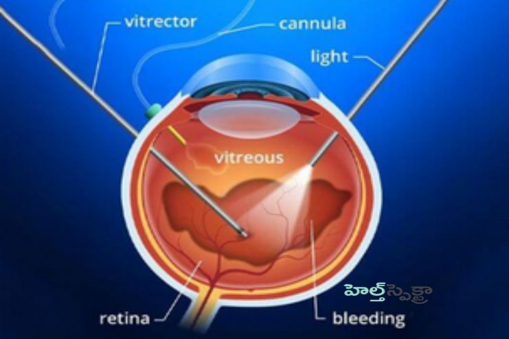 Surgery to remove the vitreous
