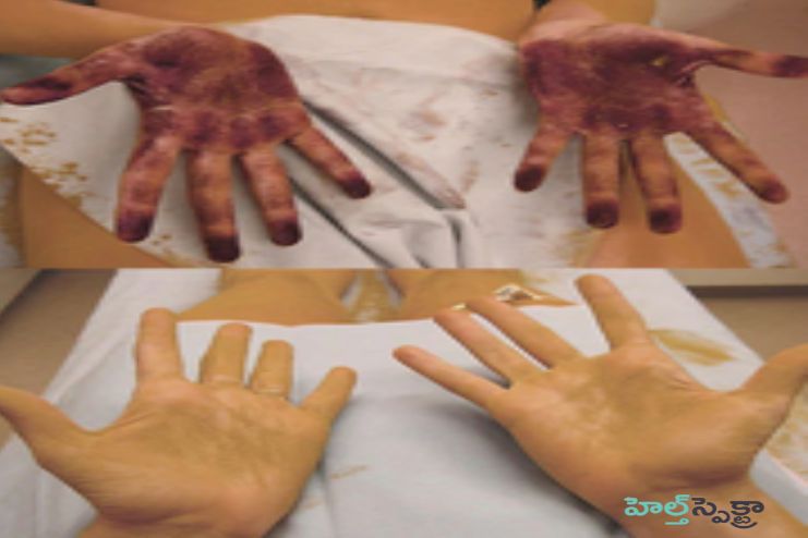 Sweat tests of Hyperhidrosis