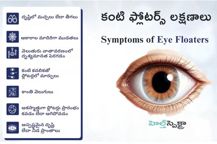 Symptoms of Eye floaters