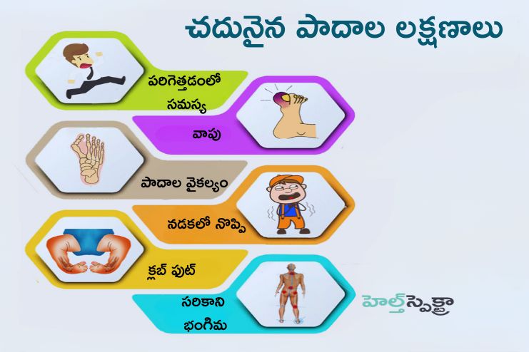 Symptoms of Flatfeet