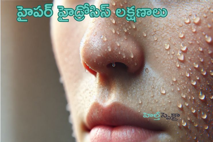 Symptoms of Hyperhidrosis